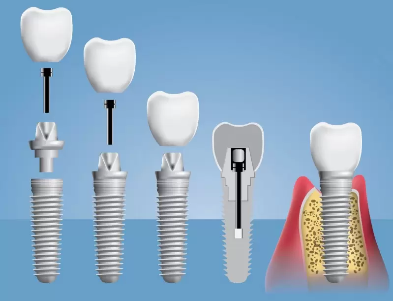 Зубной имплант