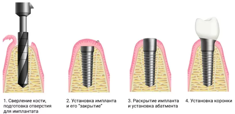 Этапы имплантации