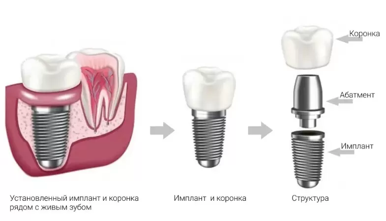 Зубной имплант