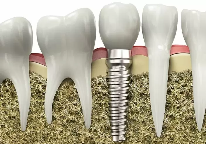 Внутрикостные импланты