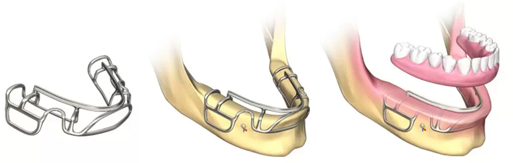 Внекостные импланты
