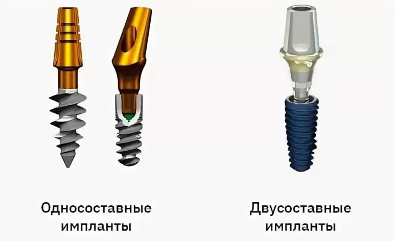 Типы конструкций зубных имплантов