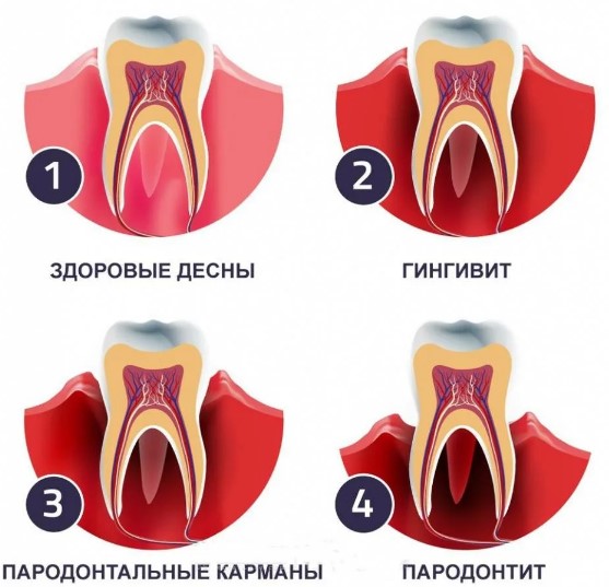 Кровоточивость десен при заболеваниях