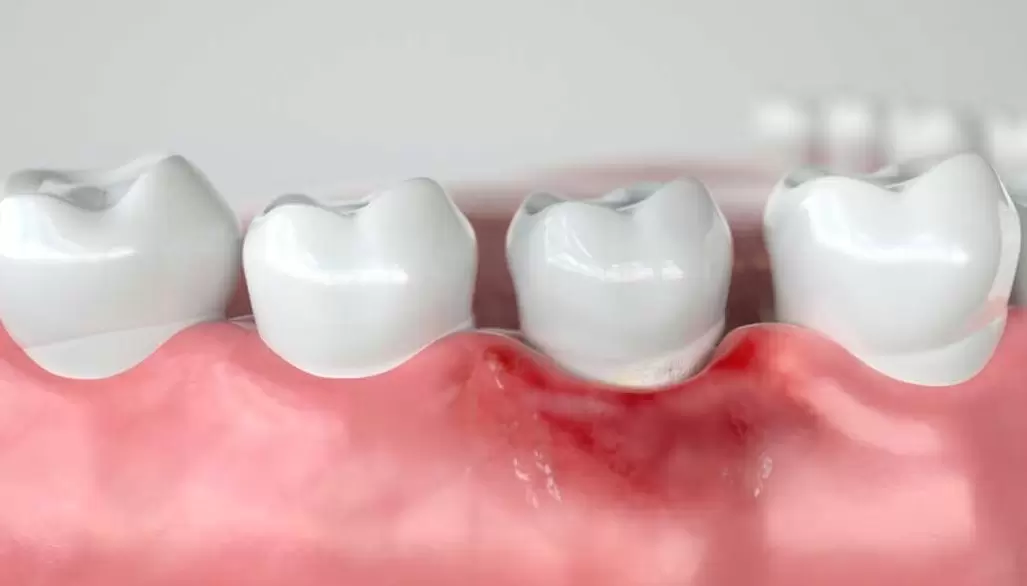 Отторжение импланта зуба