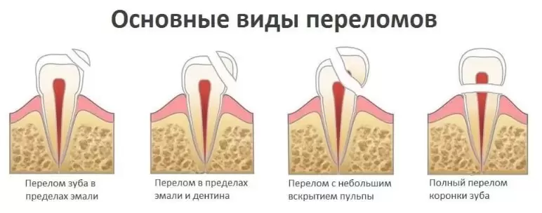 Виды сколов зуба
