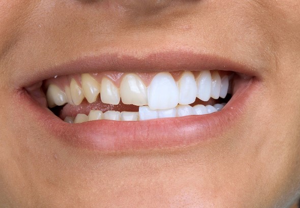 Установка виниров