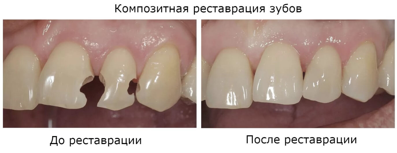 Композитная реставрация зубного ряда