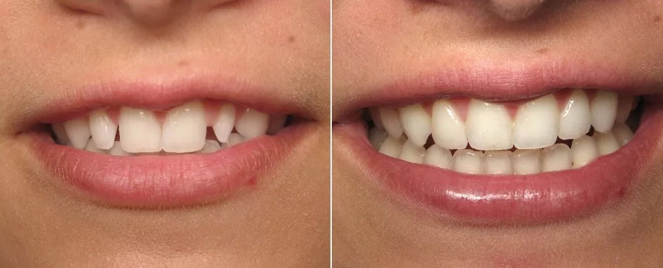 Реставрация зубного ряда коронками