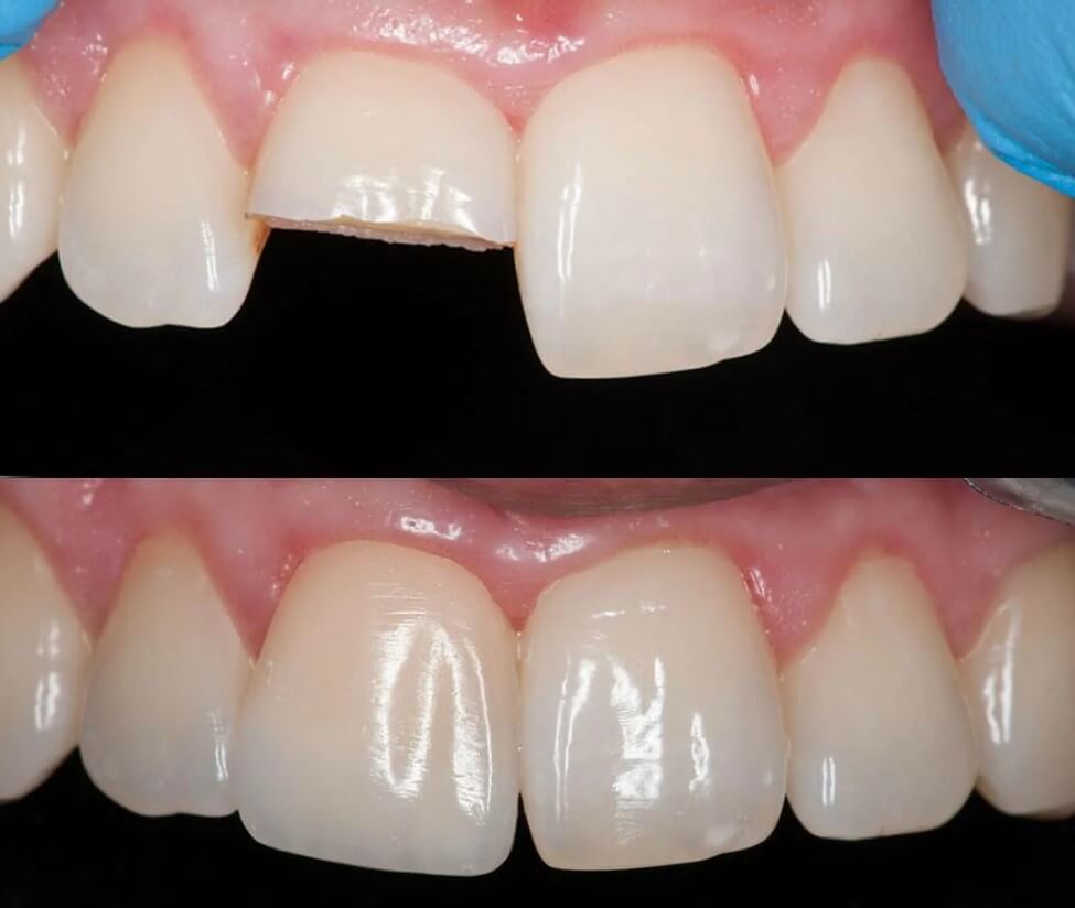 Реставрация зубов