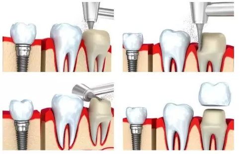 Установка зубной коронки